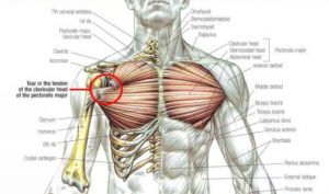 rupture, tear, pectoralis, major, tendon