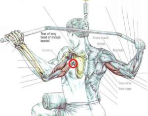 triceps, tear, rupture, pull, up, back, exercise