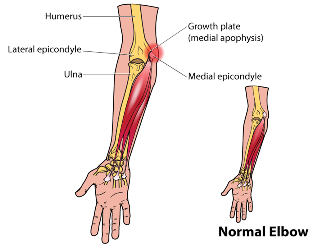 little leaguer Youth Pitcher Elbow humerus ulna radius medial apophysis epicondyle