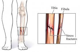 stress. fractures, tibia, fibula