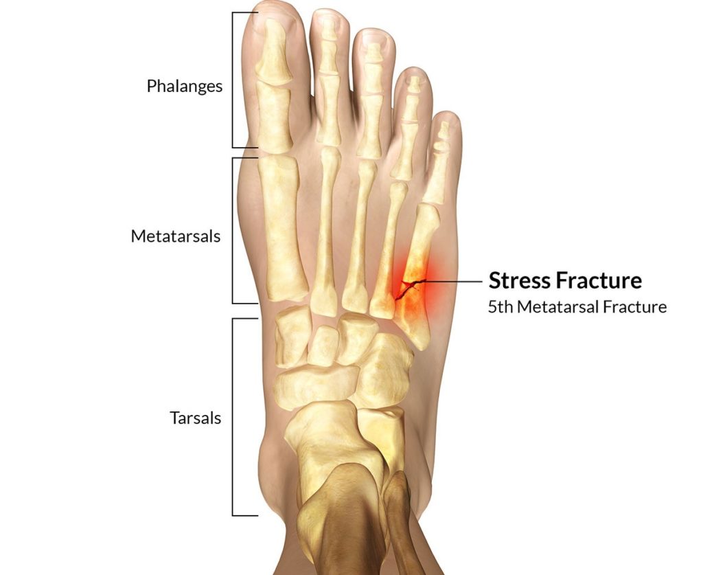 stress, fracture, foot, metatarsal, 5th