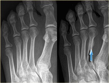 stress, fracture, foot, x-rays, metatarsal,2nd